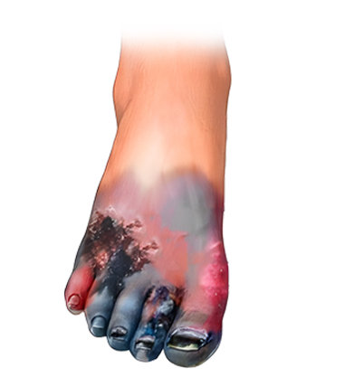 Wet gangrene illustration