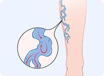 Chronic Venous Insufficiency