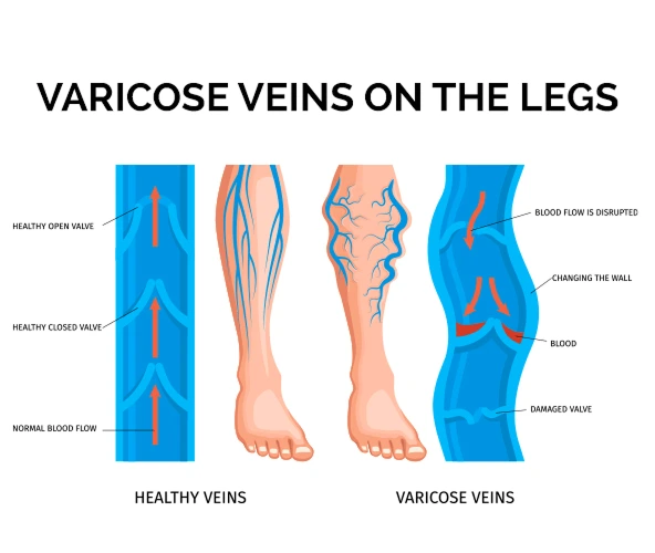varicose Treatment In Hyderabad