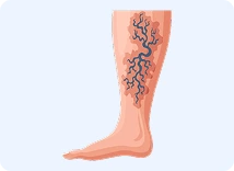 Primary Varicose Veins