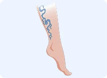 Secondary Varicose Veins