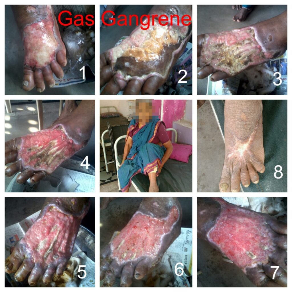 gangrene treatment kbk hospital in hyderabad