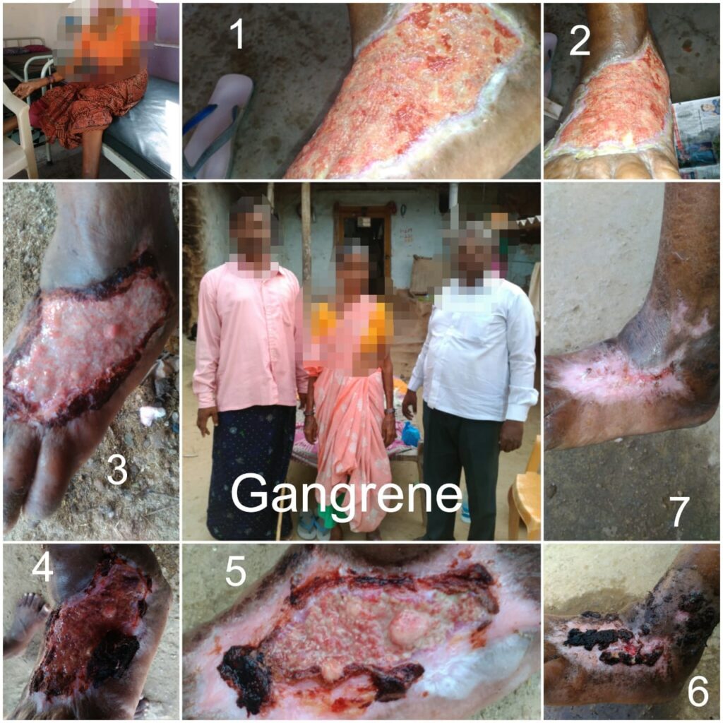 gangrene treatment in hyderabad