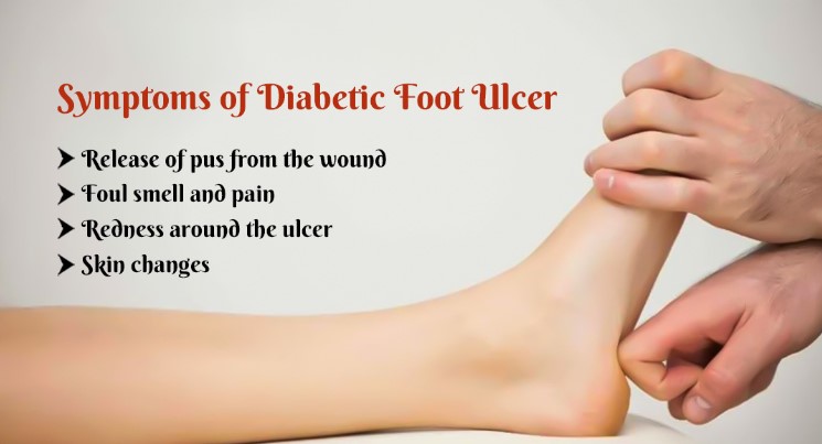 Diabetic Foot Ulcer Treatment In India without Amputation