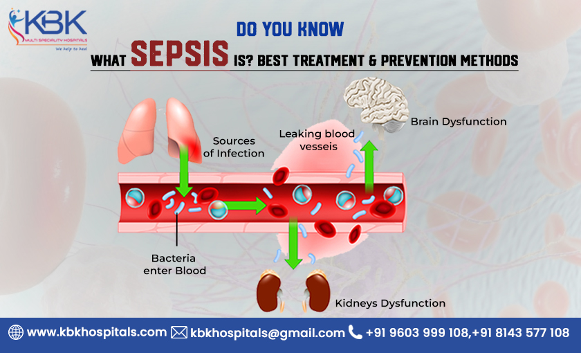 Do you know what Sepsis is, Best Treatment & Prevention methods