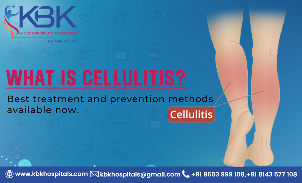What is Cellulitis, Best treatment and prevention available