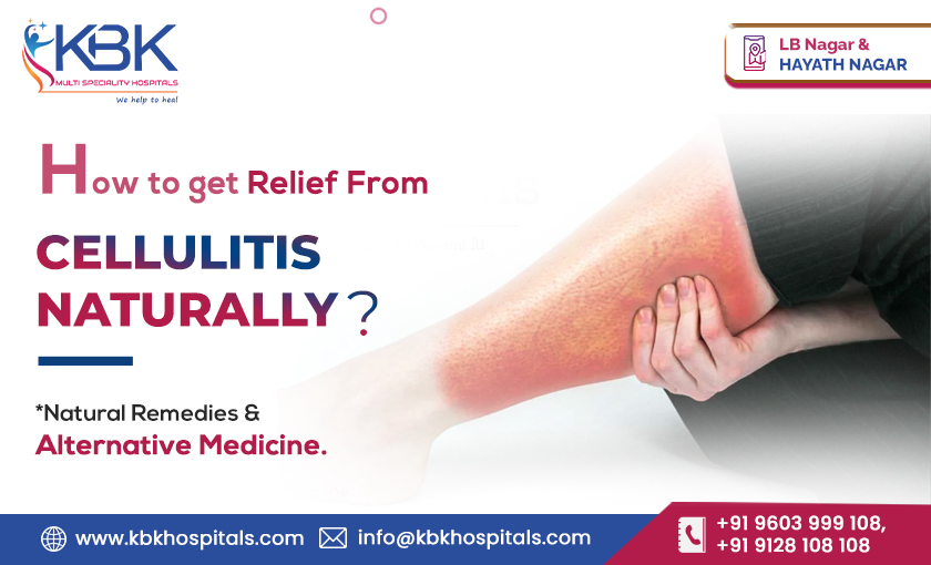 How To Get Relief From Cellulitis Naturally Natural Remedies & Alternative Medicine - KBK HOSPITALS BLOG IMAGE 2023