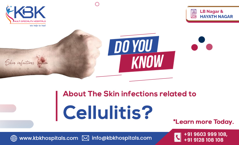 Do you know About the Skin infections related to Cellulitis Learn more Today. - KBK HOSPITALS 2023 (BLOG IMAGE)