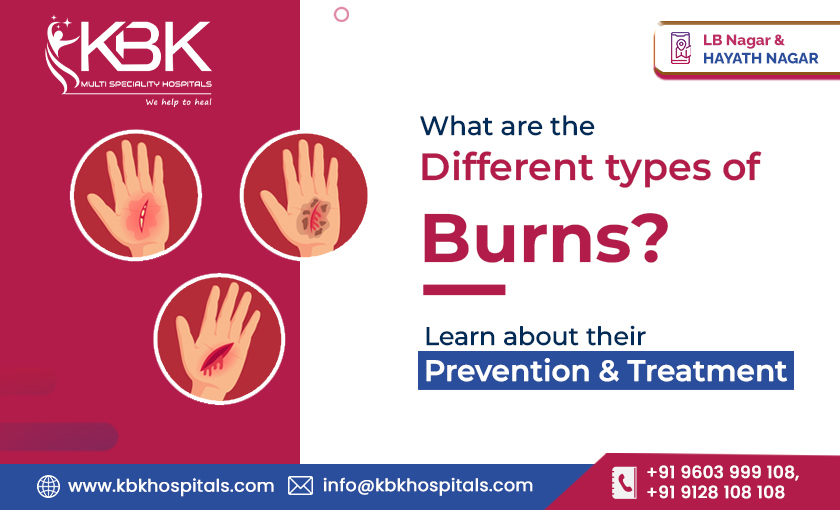What are the Different types of Burns Learn about their Prevention & Treatment. BLOG IMAGE - KBK HOSPITALS 2023