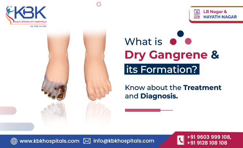 What is Dry Gangrene & its Formation Know about the Treatment and Diagnosis - KBK HOSPITALS 2023 (BLOG IMAGE)