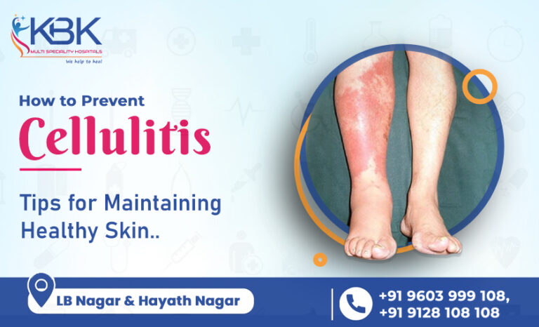 How To Prevent Cellulitis Tips For Maintaining Healthy Skin 