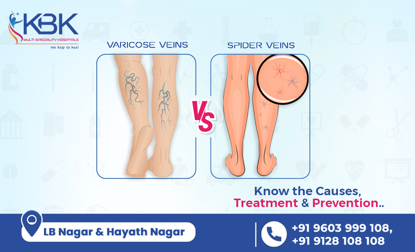 What Is the Difference Between Spider Veins and Varicose Veins?