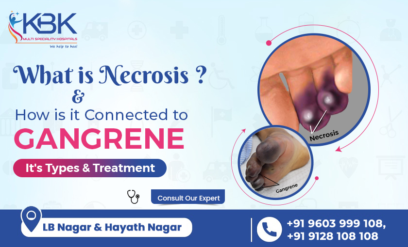 What is Necrosis & how is it connected to Gangrene It's Types & Treatment. - KBK HOSPITALS 2023 (BLOG IMAGE)