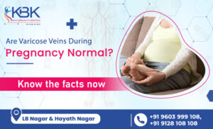 Varicose veins during pregnancy