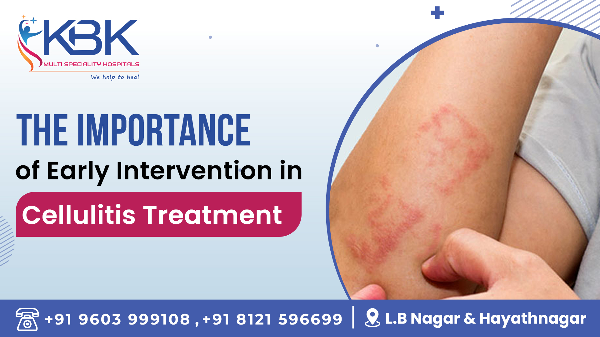 Cellulitis Treatment Cellulitis Treatment