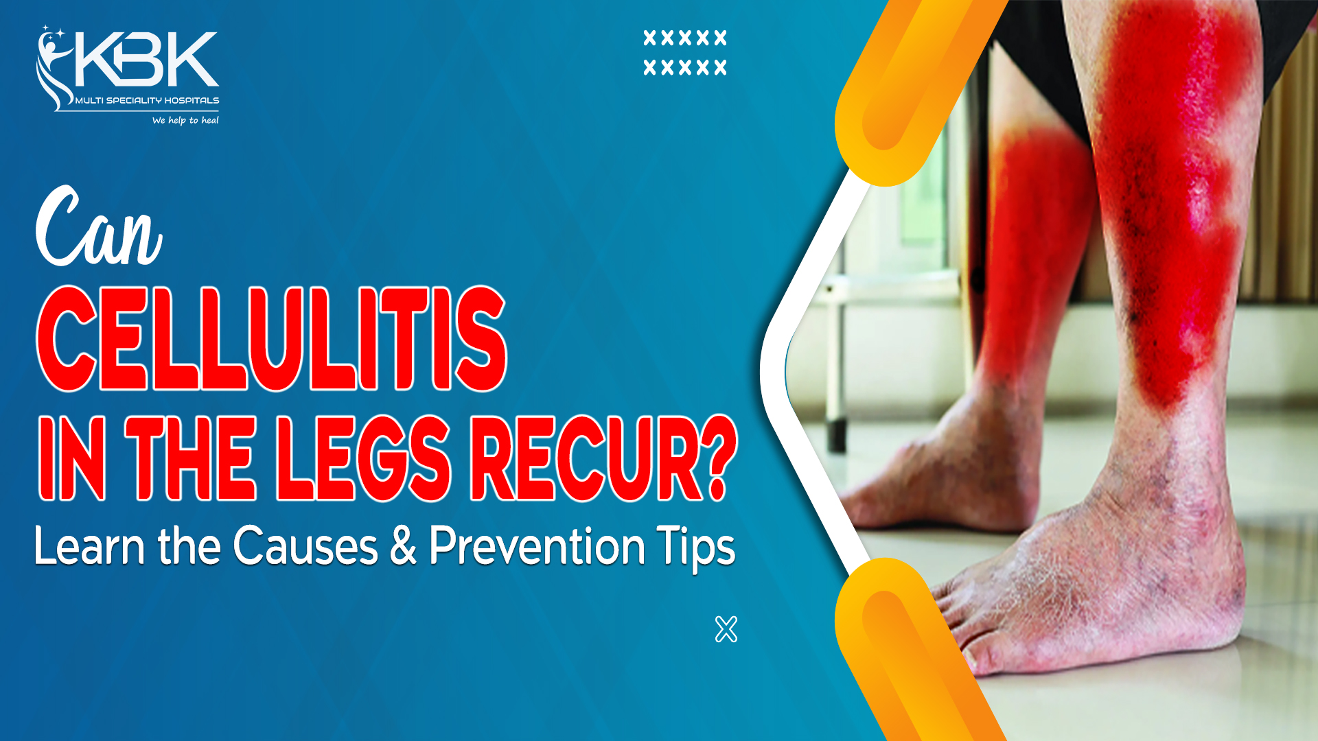 Cellulitis in legs