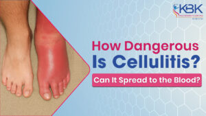 how dangerous cellulitis