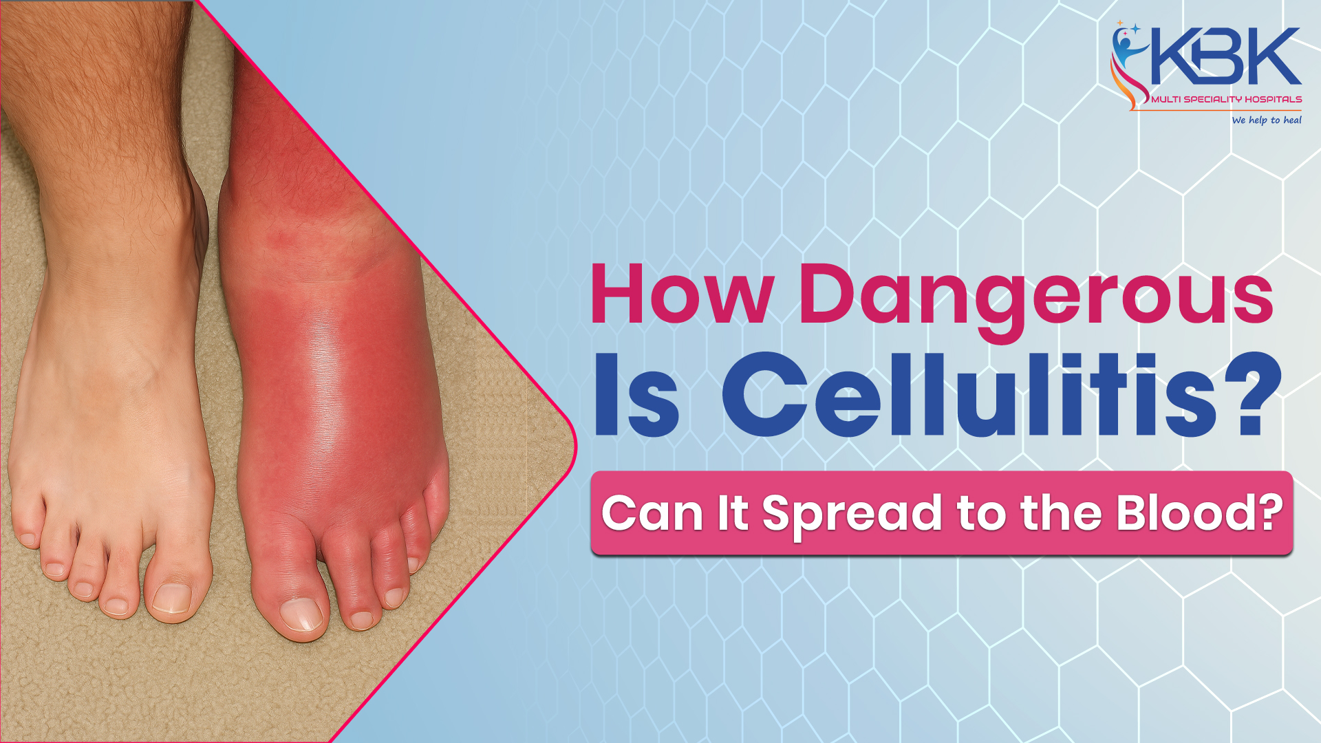 how dangerous cellulitis