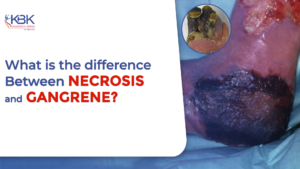 difference between necrosis and gangrene