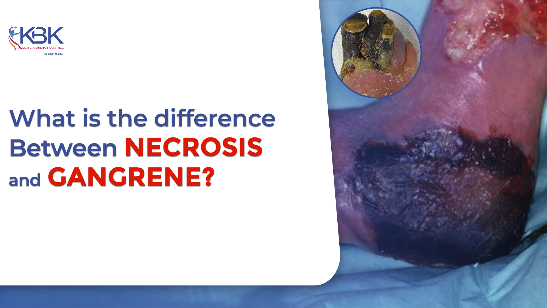 difference between necrosis and gangrene