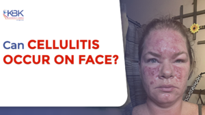 Can cellulitis occur on face
