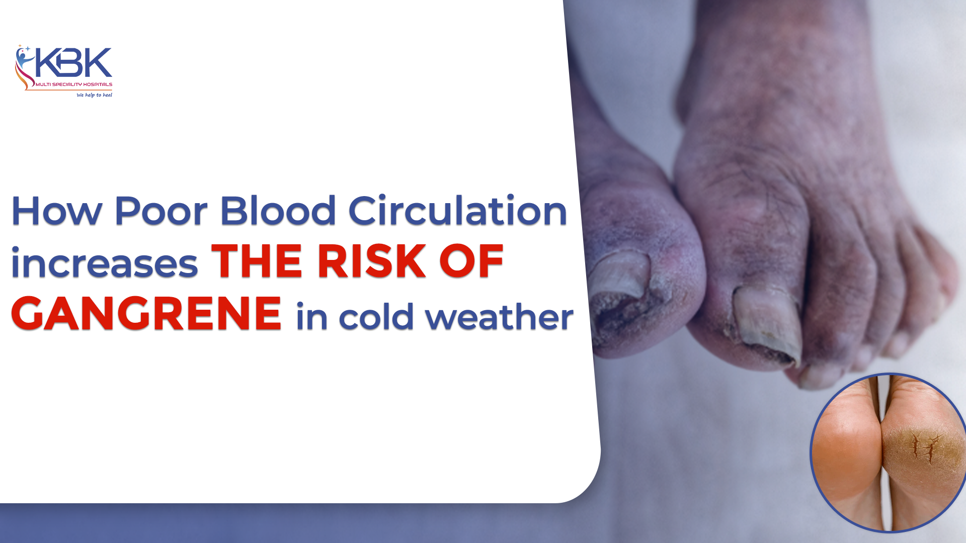 How Poor Blood Circulation Increases the Risk of Gangrene in Cold Weather