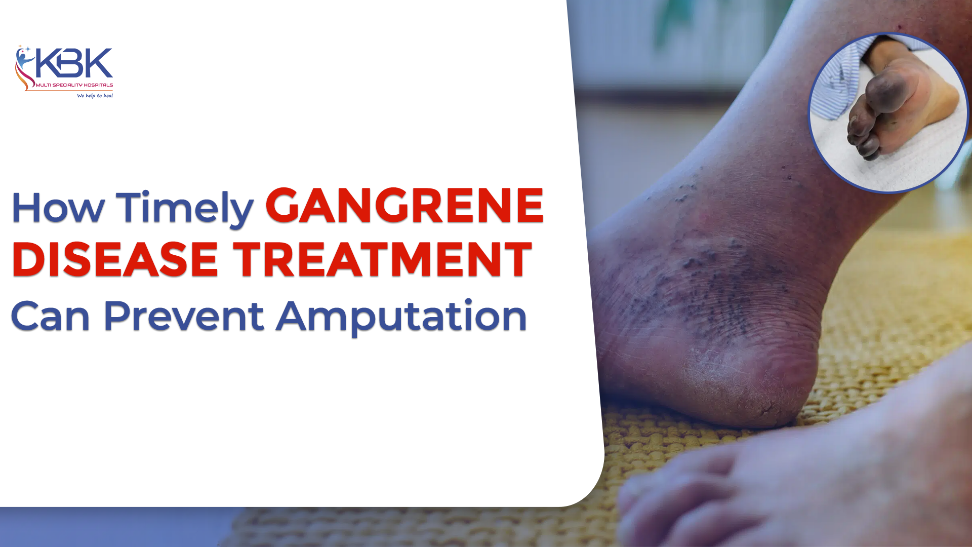 How Timely Gangrene Disease Treatment Can Prevent Amputation