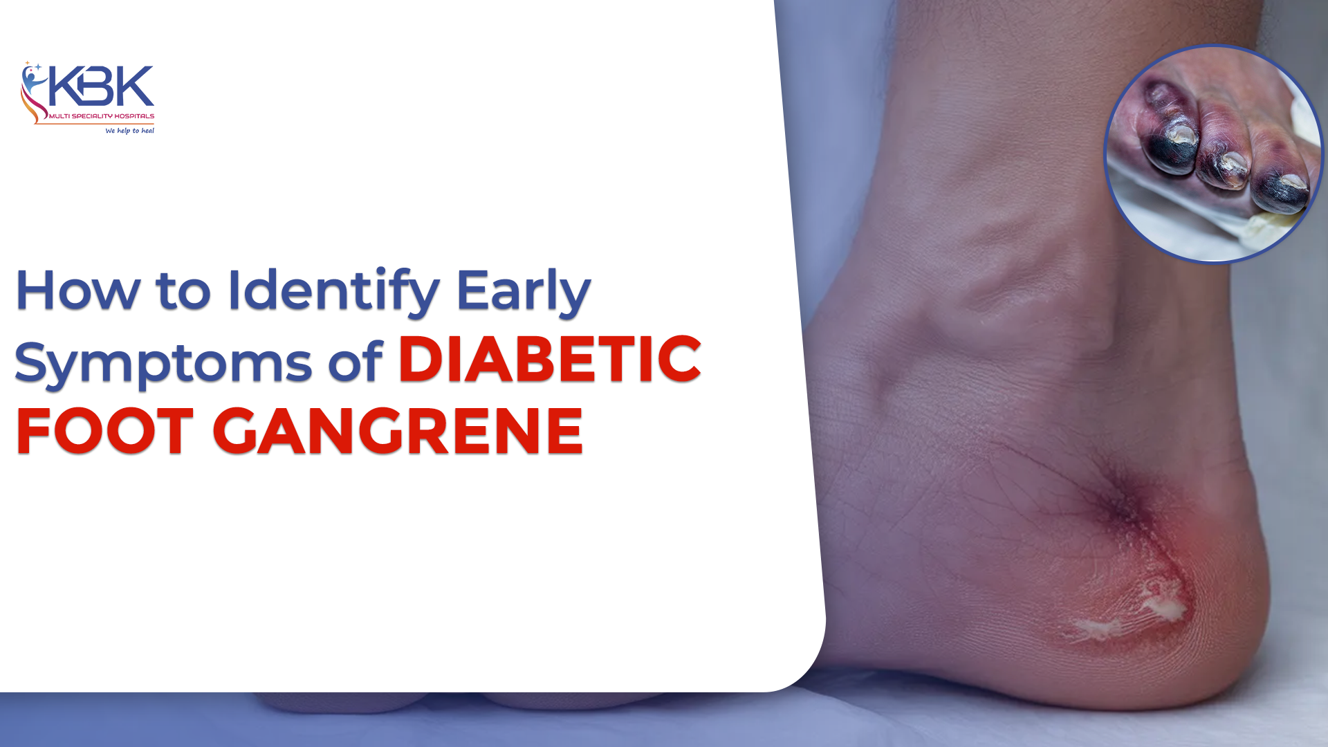 How to Identify Early Symptoms of Diabetic Foot Gangrene