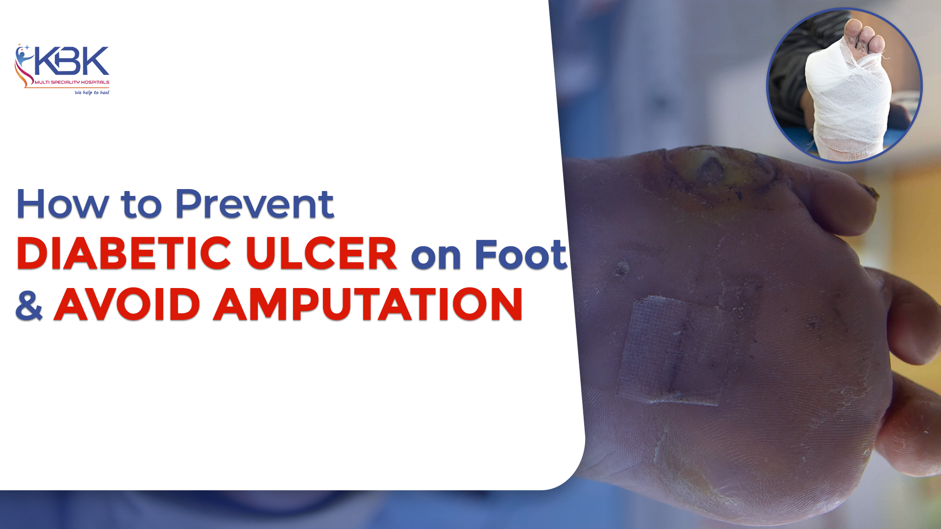 How to Prevent Diabetic Ulcer on Foot and Avoid Amputation