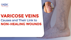 Varicose Veins Causes and Their Link to Non-Healing Wounds
