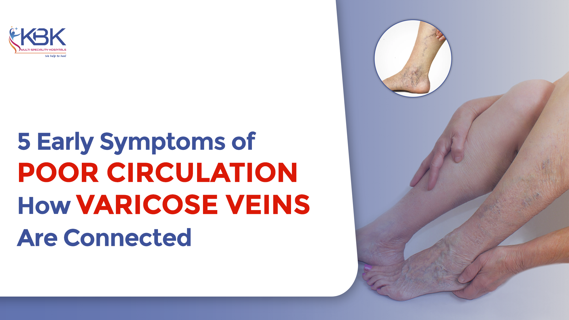 5 Early Symptoms of Varicose Veins due to poor circulation in legs