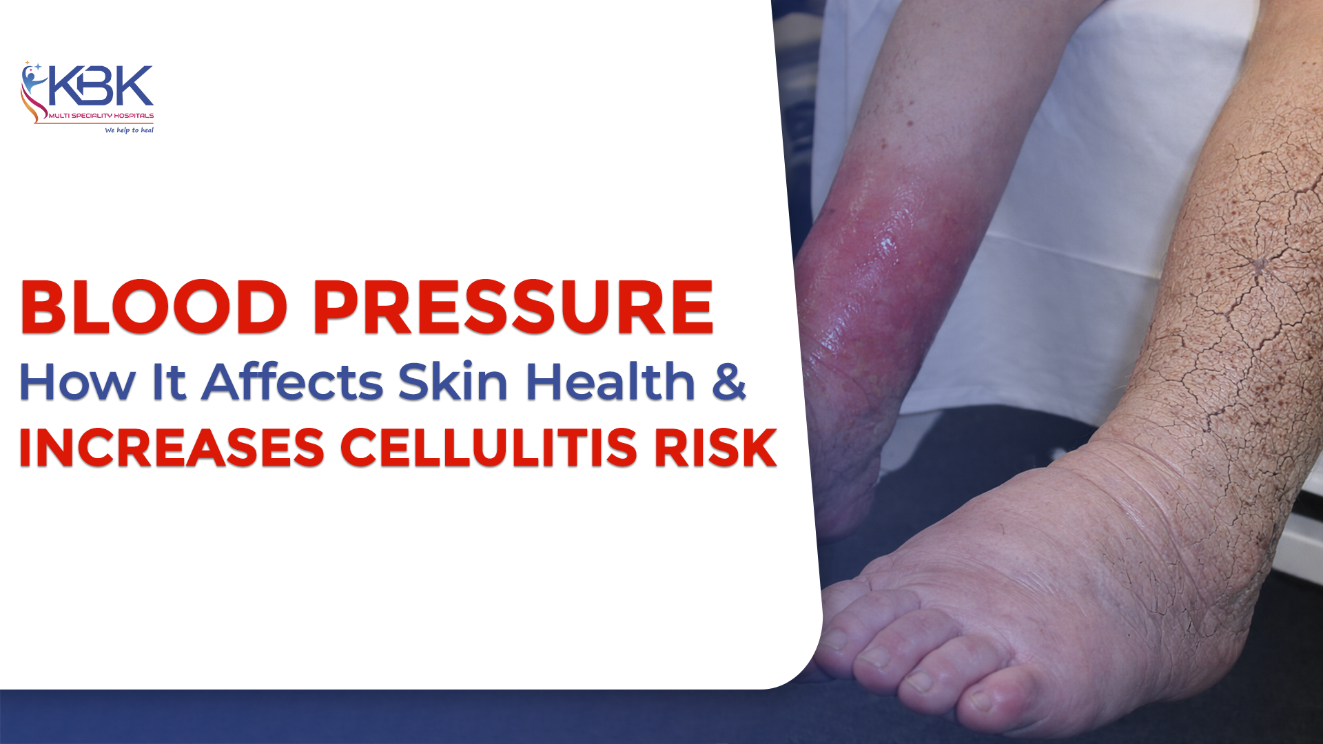 Blood Pressure: How Dry and Cracked Skin Increases the Risk of Cellulitis