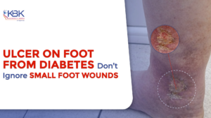 ulcer on foot from diabetes