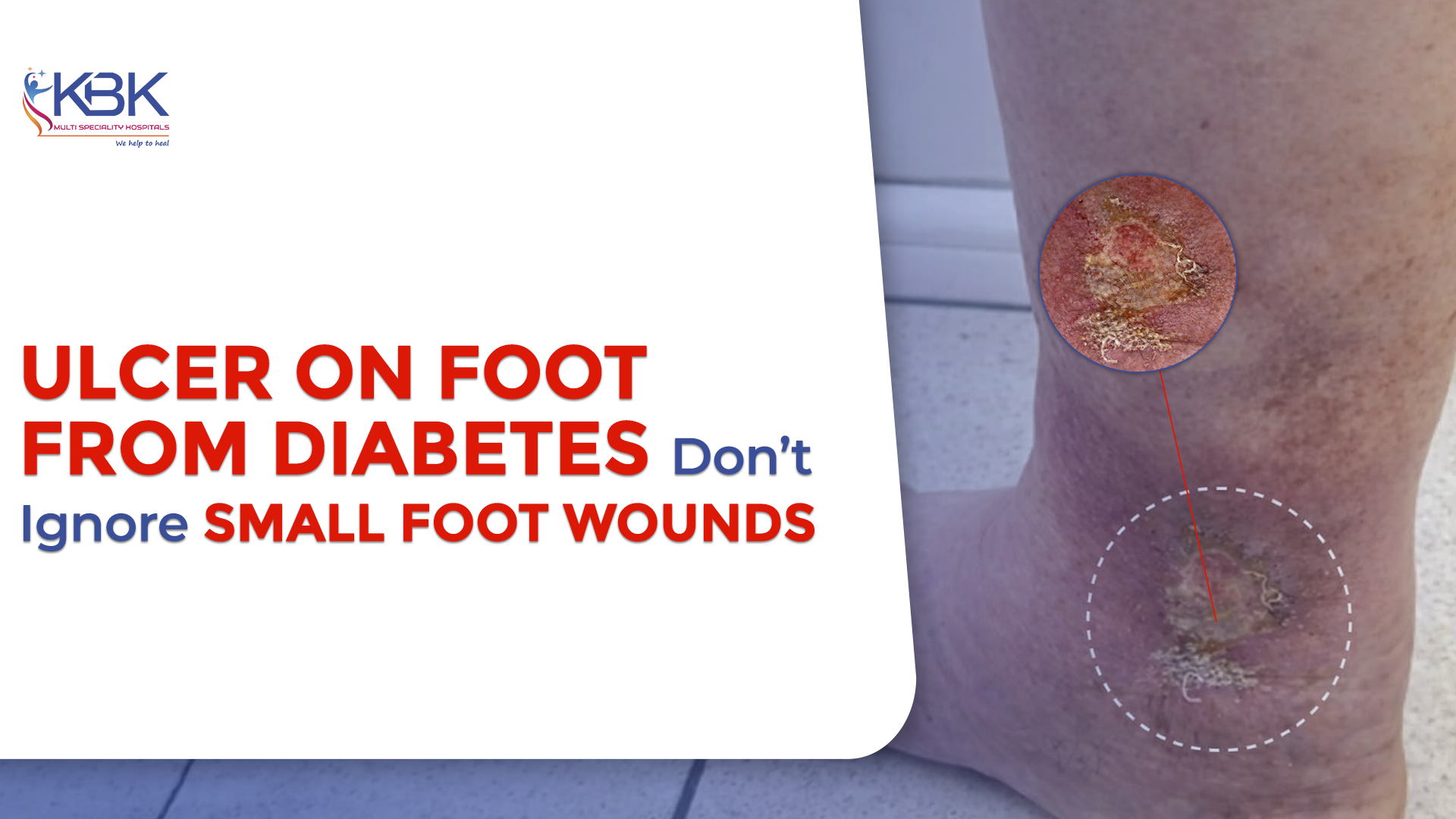 ulcer on foot from diabetes