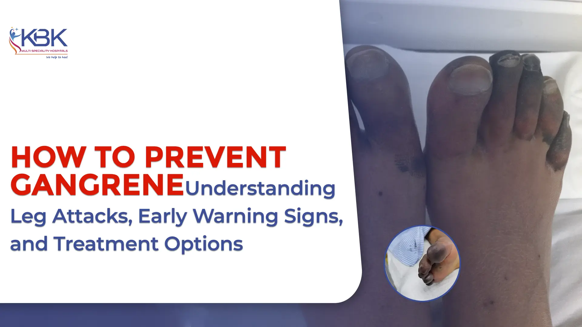 From Leg Attack to Gangrene: Steps Toward Understanding and Healing How to Prevent Gangrene