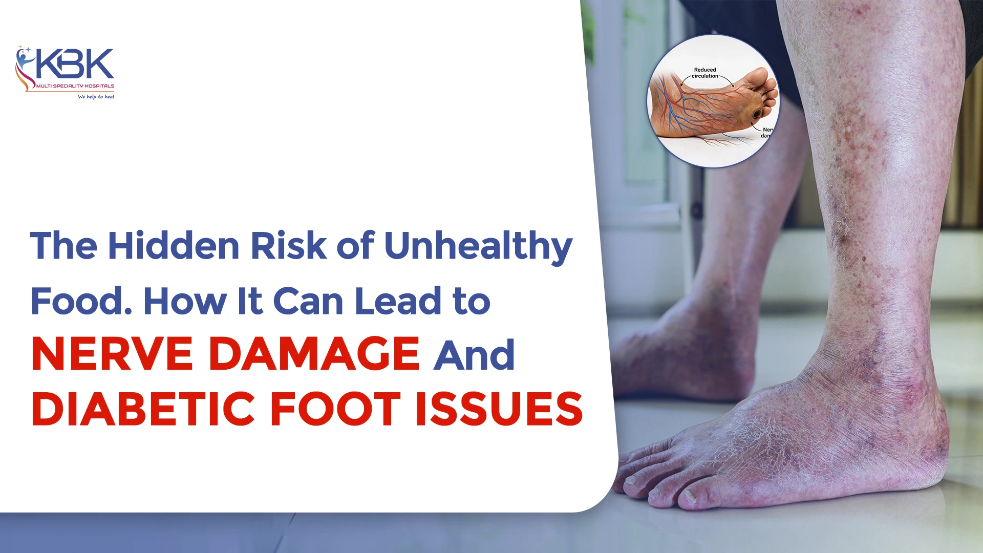 Nerve Damage: How Unhealthy Food Can Lead to Diabetic Foot Problems