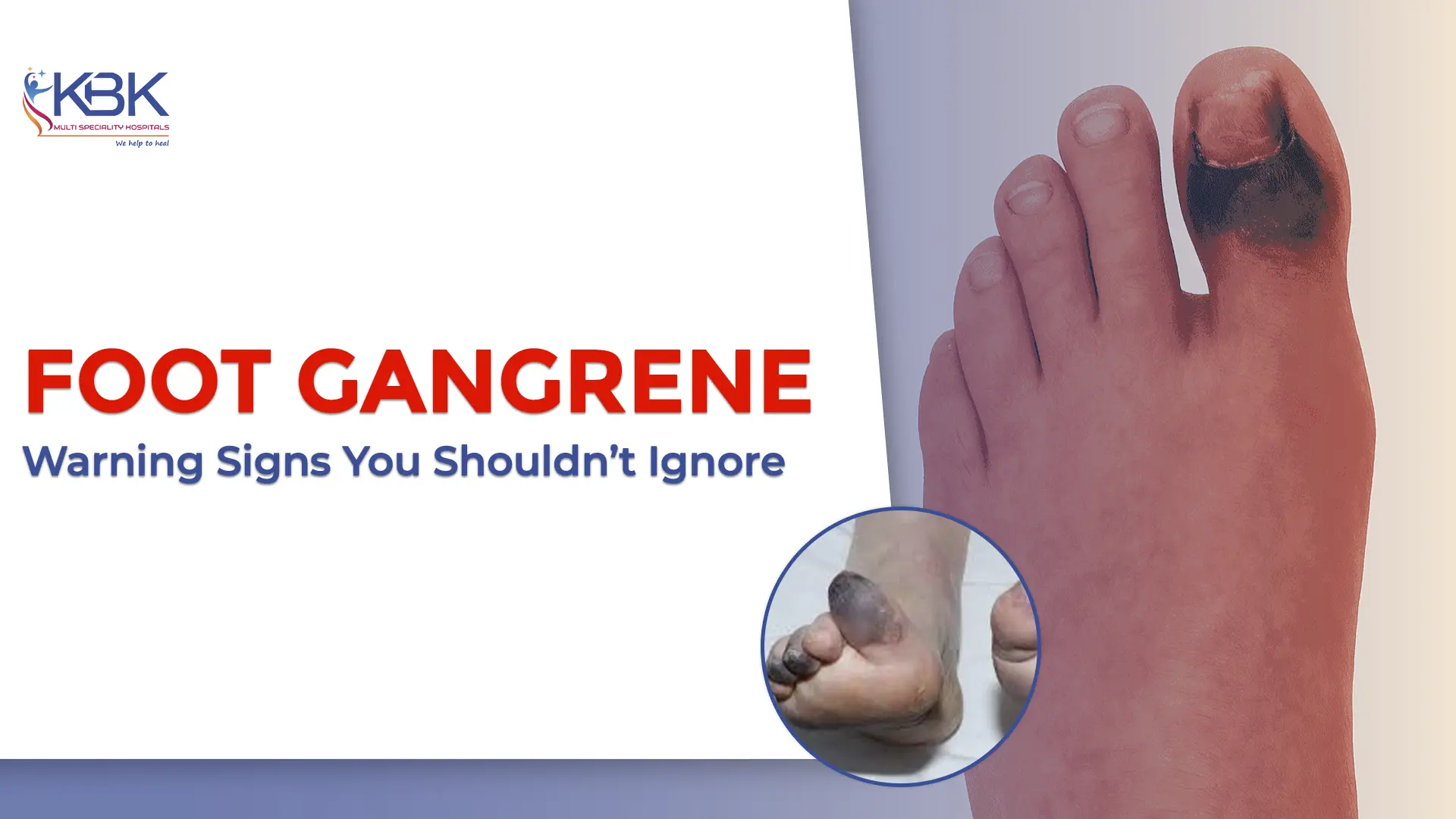 Foot Gangrene: Warning Signs You Shouldn’t Ignore