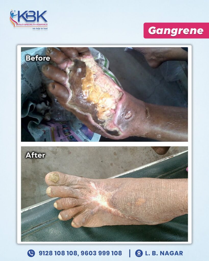 From Severe Gangrene to Complete Healing