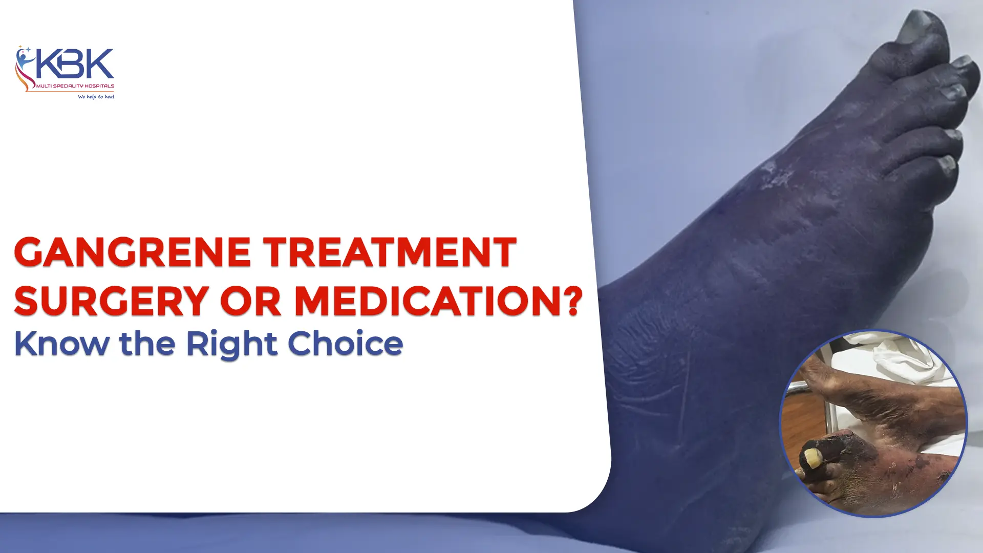 Gangrene Treatment Options: Surgery vs Medication