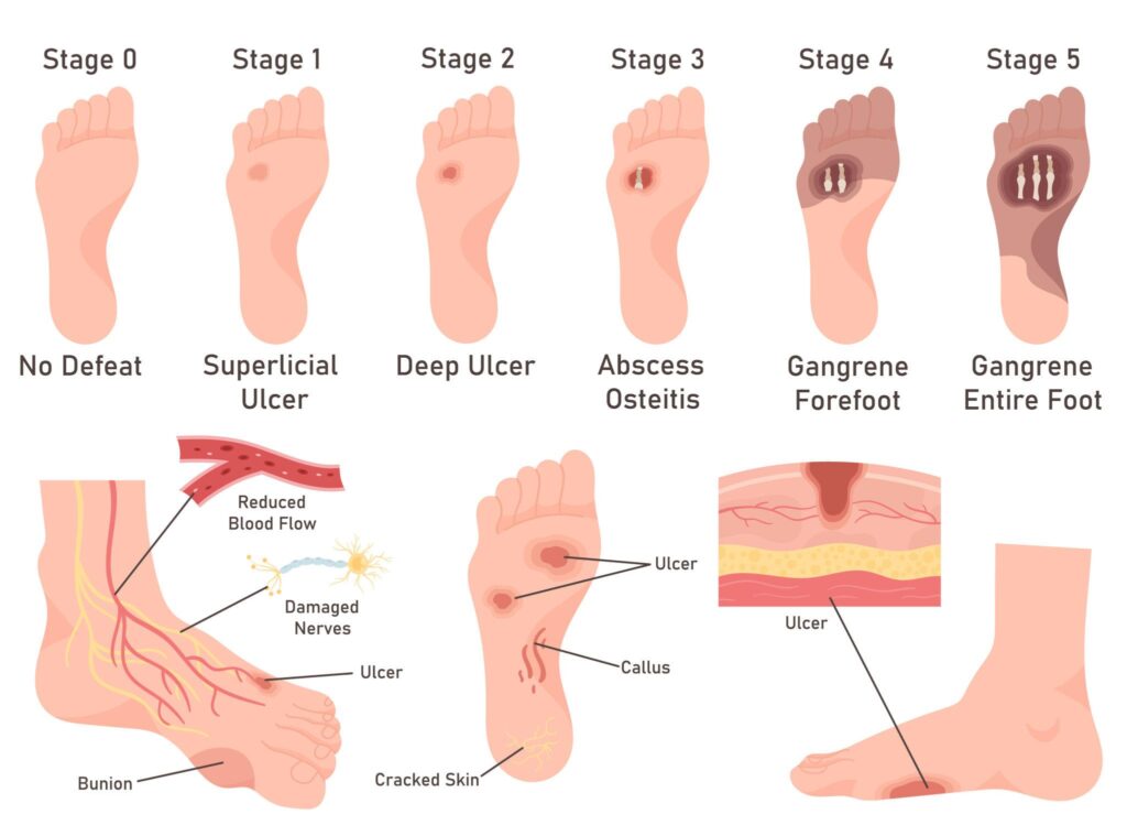 Foot Gangrene stages from early ulcer to severe tissue damage and full foot gangrene