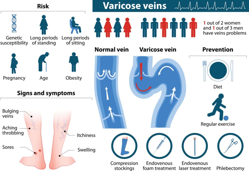 Symptoms of varicose veins including swelling and pain