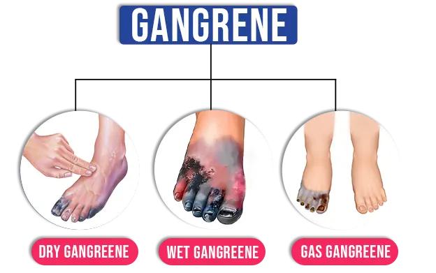 Early signs of gangrene in foot discoloration and infection