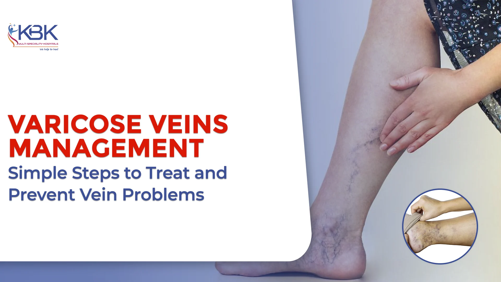 Management of Varicose Veins: Treatments, Lifestyle Changes, and Prevention Tips
