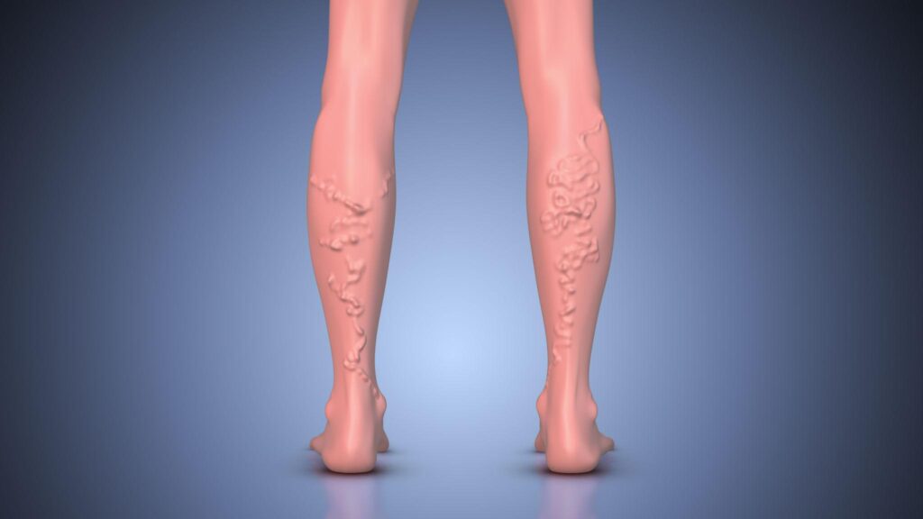 Varicose veins in legs showing swollen twisted veins