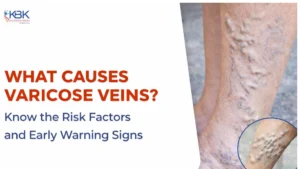 causes of varicose veins