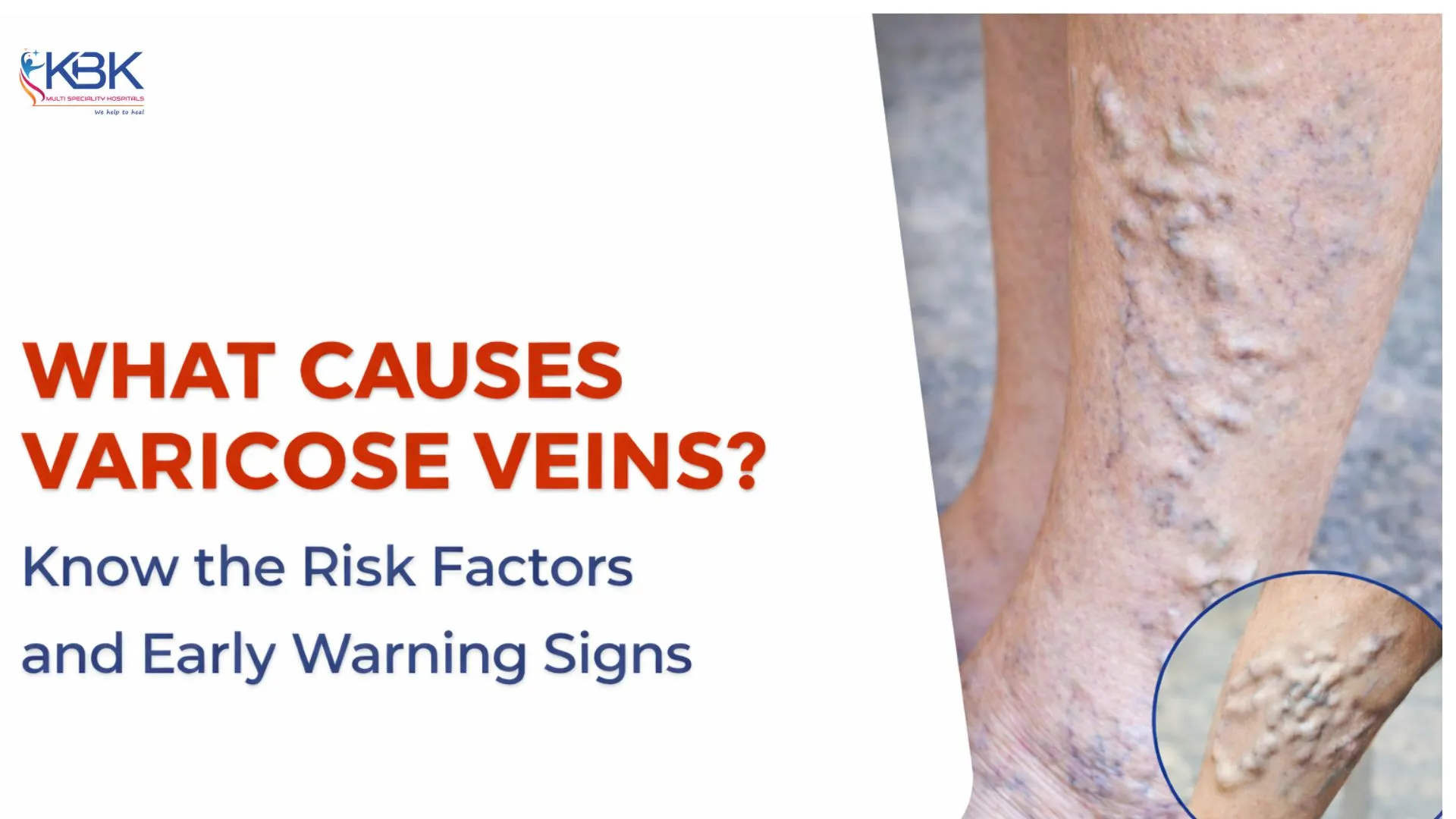 causes of varicose veins