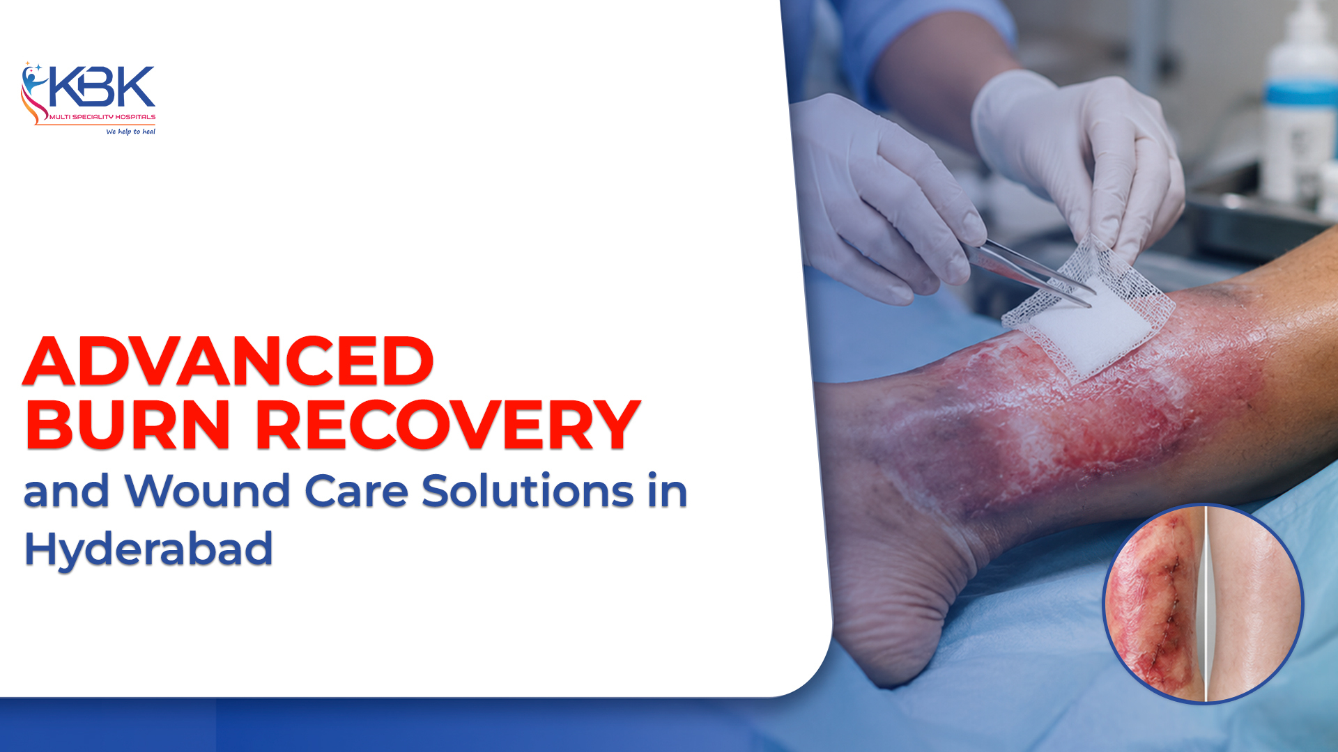 Advanced Burn Recovery and Wound Care Solutions in Hyderabad