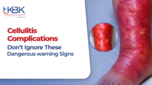 Cellulitis Complications