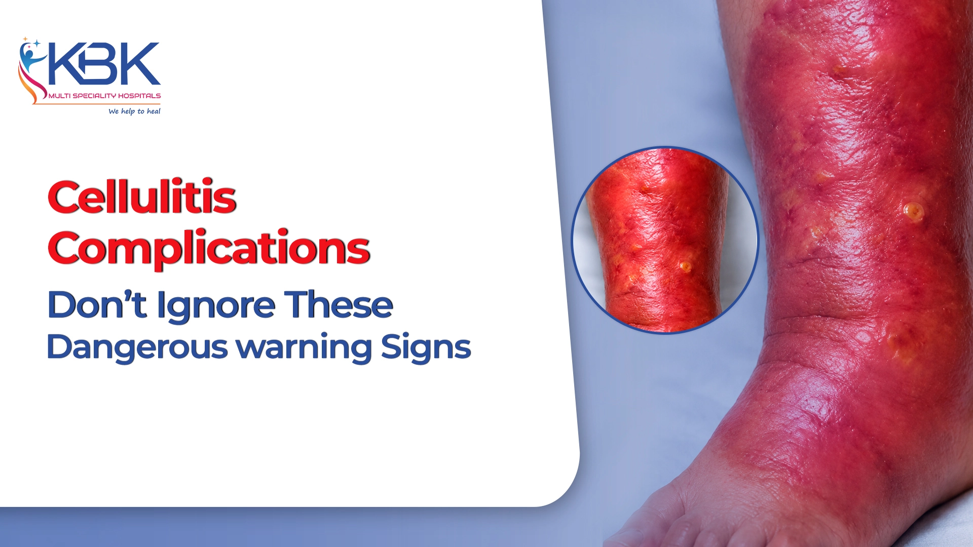 Cellulitis Complications
