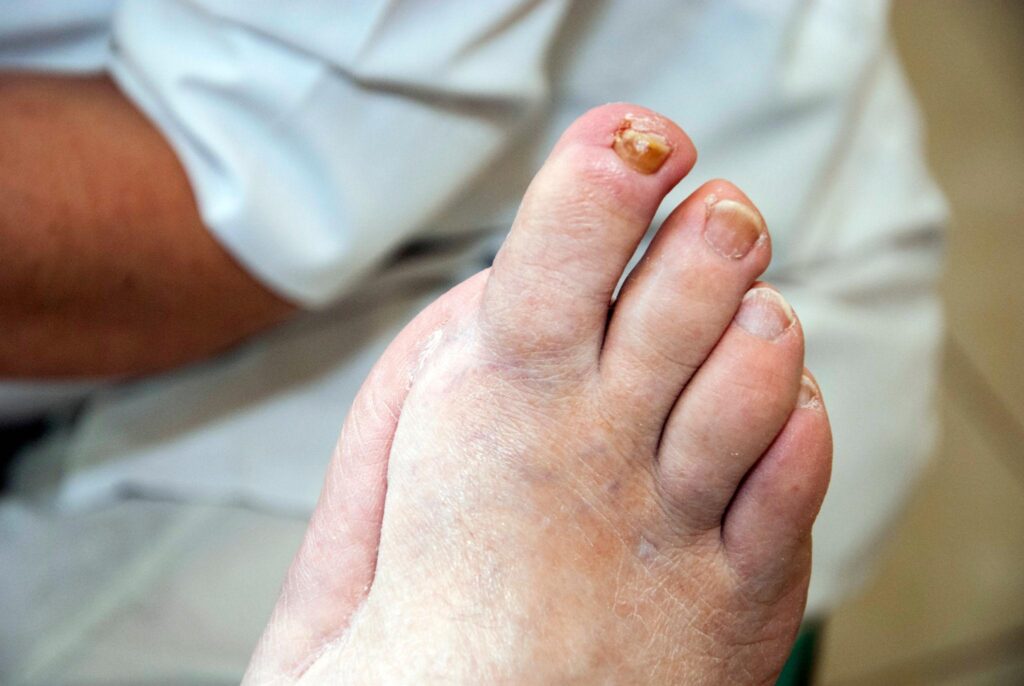 Diabetic foot care routine to prevent infections and complications